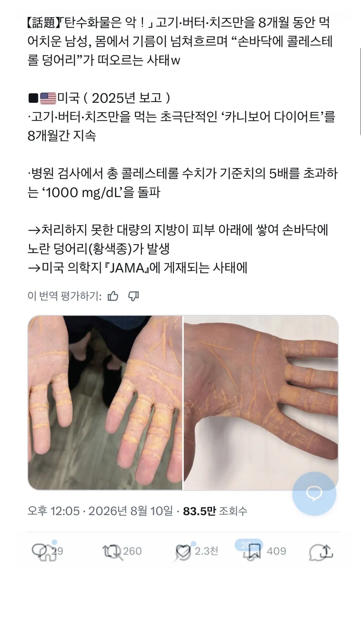 고기, 버터, 치즈만 먹는 극단적 다이어트를 한 사람의 손ㄷㄷ