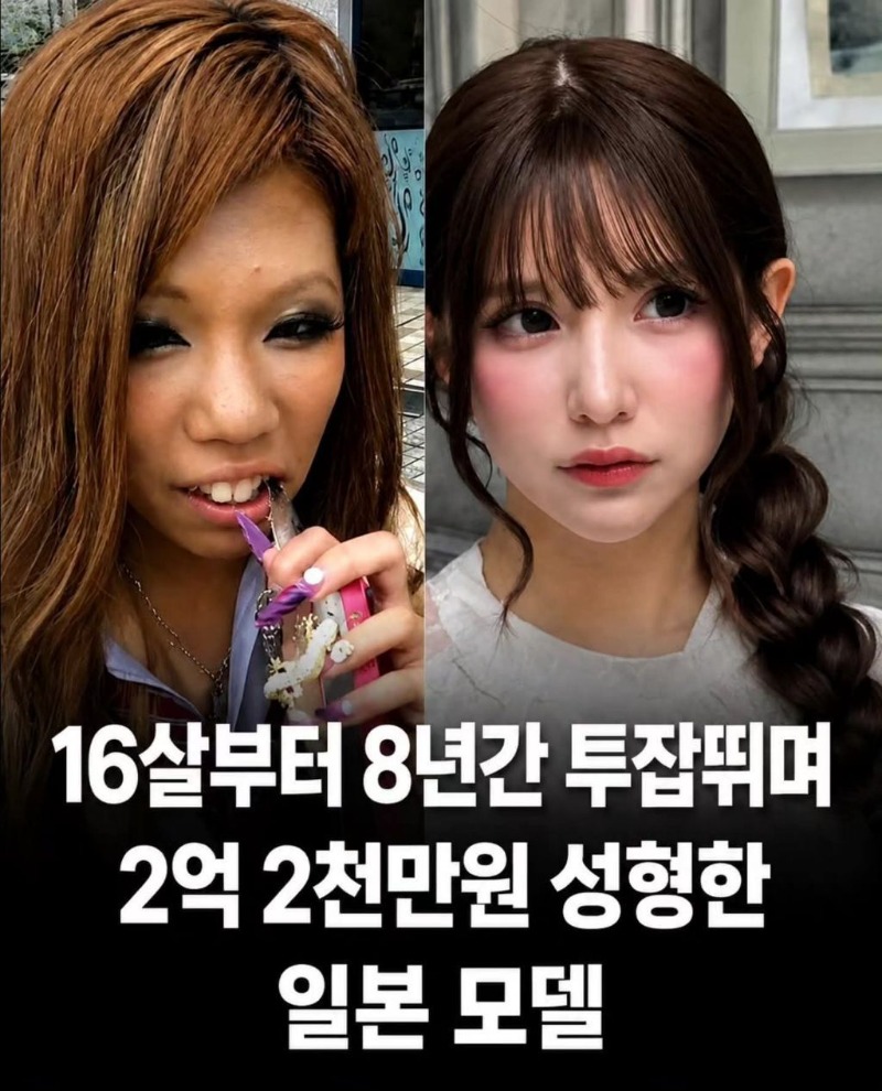 성형 2억2천쓴 일본녀